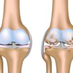 Комплексный подход к лечению остеоартроза коленных суставов