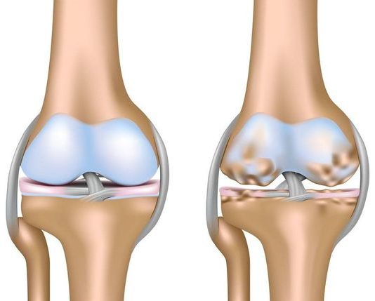 Комплексный подход к лечению остеоартроза коленных суставов