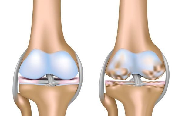 Комплексный подход к лечению остеоартроза коленных суставов