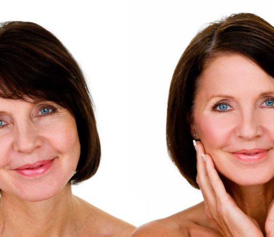 Ботокс для лица