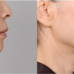 Липосакция подбородка: быстрый и надежный способ избавиться от проблемной зоны и сопутствующего морального дискомфорта