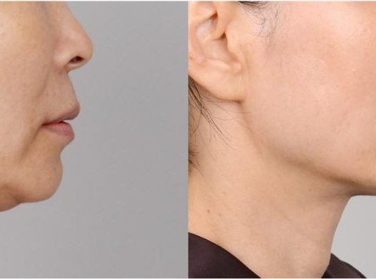 Липосакция подбородка: быстрый и надежный способ избавиться от проблемной зоны и сопутствующего морального дискомфорта