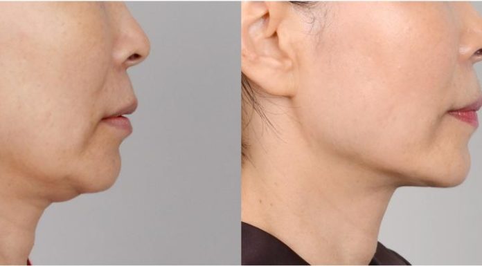Липосакция подбородка: быстрый и надежный способ избавиться от проблемной зоны и сопутствующего морального дискомфорта