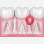 Как избавиться от воспаления десен?