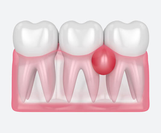 Как избавиться от воспаления десен?