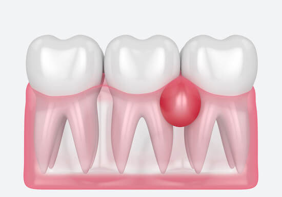 Как избавиться от воспаления десен?