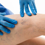 Что нужно знать о варикозе?