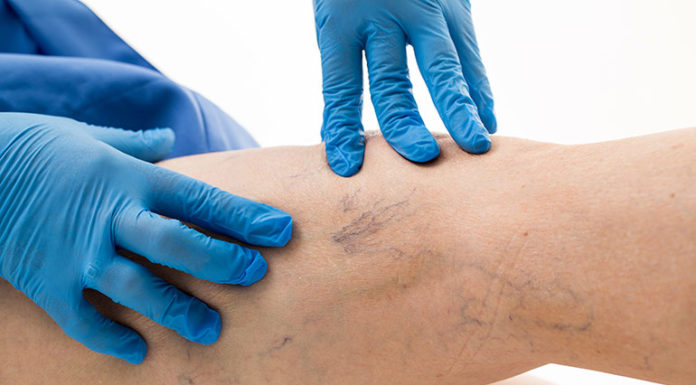 Что нужно знать о варикозе?