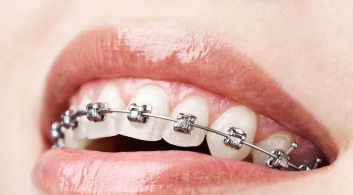 Исправление прикуса при помощи брекет систем