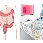 В каком случае назначают колоноскопию?