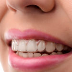 ФлексиЛайнер — это эффективное решение для исправления прикуса без брекетов