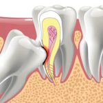 Нужно ли удалять зубы мудрости и в каких случаях?