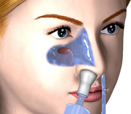 Промывание носа методом Кукушка при гайморите: плюсы и минусы