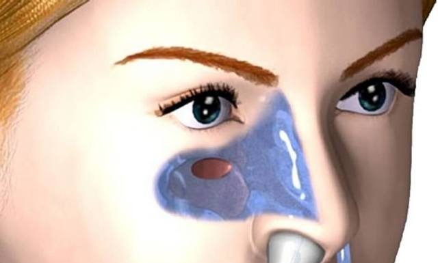 Промывание носа методом Кукушка при гайморите: плюсы и минусы