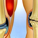 Комплексный подход к лечению артроза коленных суставов