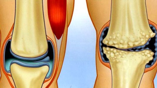 Комплексный подход к лечению артроза коленных суставов