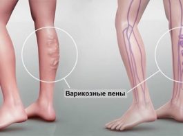 Современные методы лечения варикозной болезни