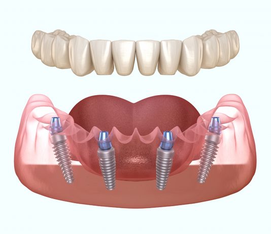 Почему важно вовремя поставить имплантат?