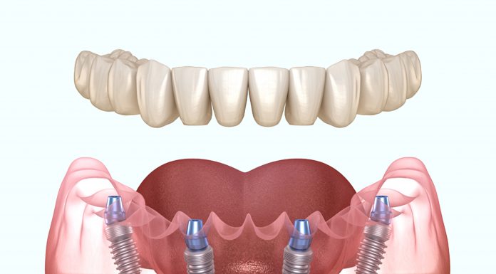 Почему важно вовремя поставить имплантат?