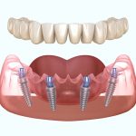 Имплантация зубов в Алматы