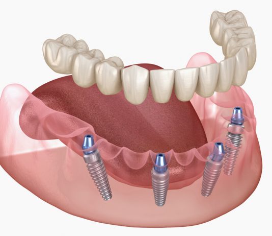 All-on-4-имплантация: протезирование зубов с немедленной нагрузкой
