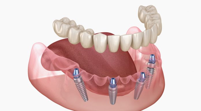 All-on-4-имплантация: протезирование зубов с немедленной нагрузкой