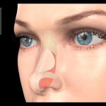 Выравнивание носовой перегородки: показания к процедуре, особенности операции и реабилитации