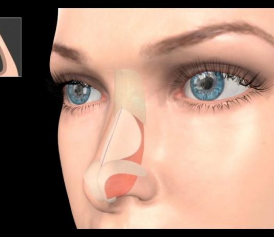 Выравнивание носовой перегородки: показания к процедуре, особенности операции и реабилитации