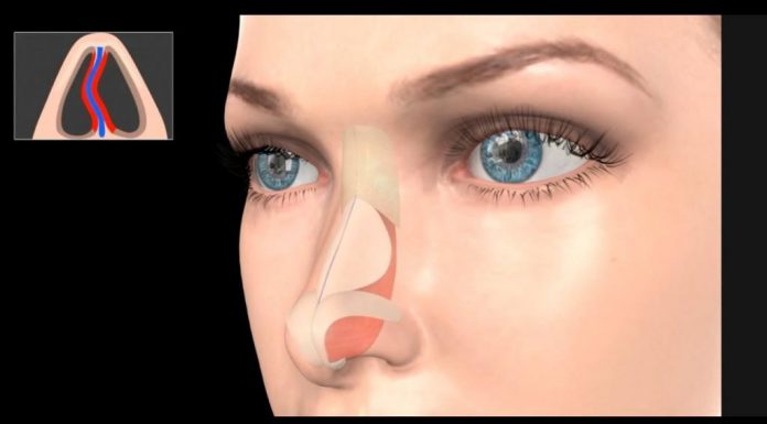 Выравнивание носовой перегородки: показания к процедуре, особенности операции и реабилитации