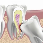 Когда нужно удалять зубы мудрости?