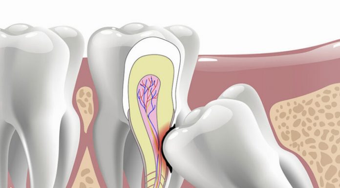 Когда нужно удалять зубы мудрости?