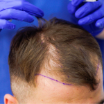 Технология пересадки волос без рубцов методом HFE