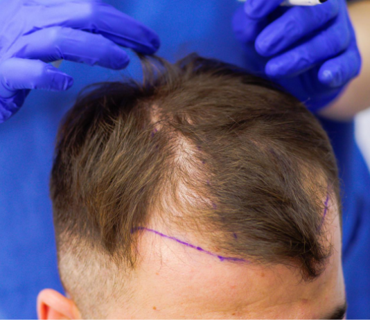 Технология пересадки волос без рубцов методом HFE