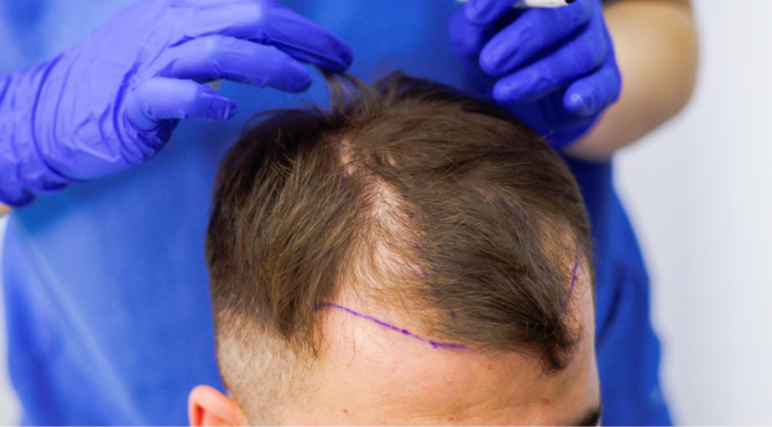 Технология пересадки волос без рубцов методом HFE