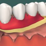 Пластика десны: как проходит операция?