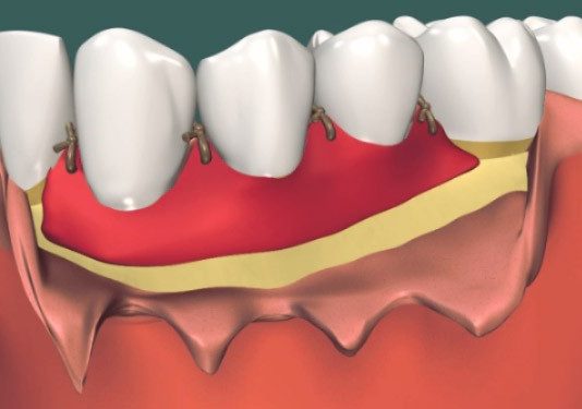 Пластика десны: как проходит операция?