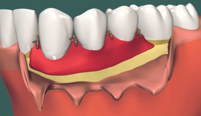 Пластика десны: как проходит операция?