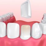 Виниры для зубов: виды, показания, установка