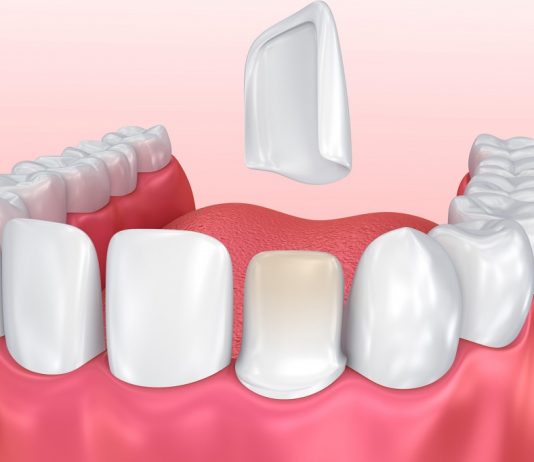 Виниры для зубов: виды, показания, установка