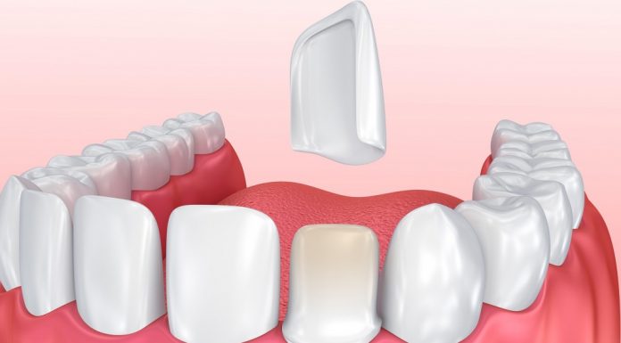 Виниры для зубов: виды, показания, установка