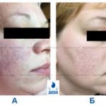 Методы оптимизации лечения и профилактики рубцов