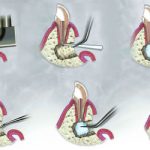 Методы резекции корня зуба