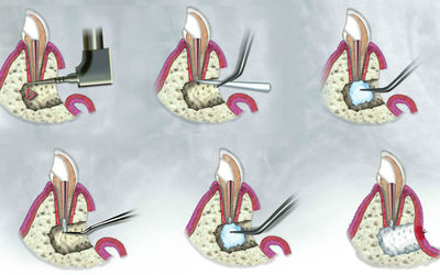 Методы резекции корня зуба