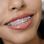 Как долго нужно носить брекеты на зубах?