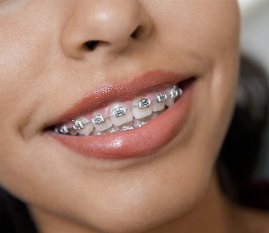 Как долго нужно носить брекеты на зубах?