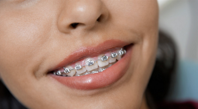 Как долго нужно носить брекеты на зубах?