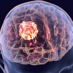 Глиобластома головного мозга