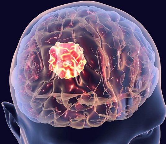 Глиобластома головного мозга