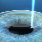 Почему лазерную коррекцию зрения ReLex SMILE делают не во всех клиниках?