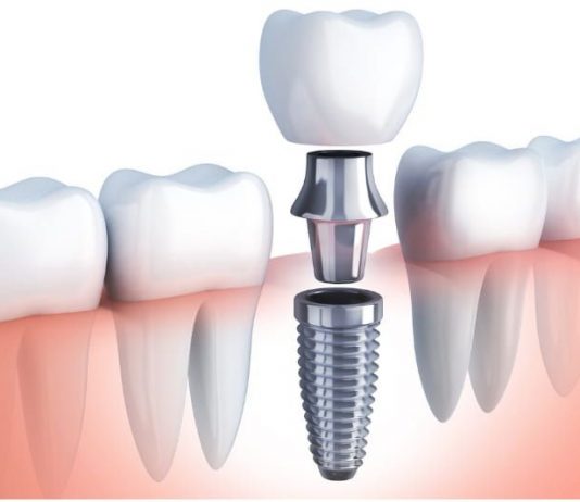 Технологии имплантации без костной пластики